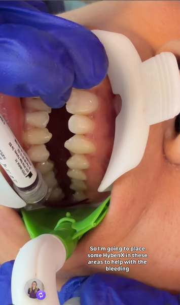 HygieneEdge uses ReLeaf with HybenX