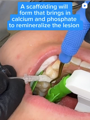 Shelley the Hygienist Uses ReLeaf